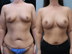 Breast Augmentation Before & After Photos