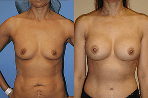 Breast Augmentation Before & After Photos