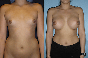Breast Augmentation Before & After Photos
