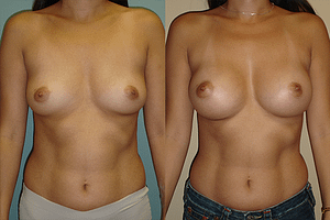 Breast Augmentation Before & After Photos Front