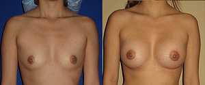Breast Augmentation Before & After Photos