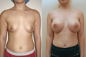 Breast Augmentation Before & After Photos