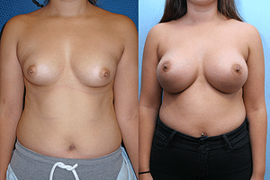 Breast Augmentation Before & After Photos
