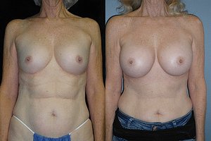 Breast Augmentation Before & After Photos