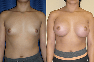 Breast Augmentation Before & After Photos
