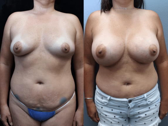 Breast Augmentation with Asymmetry Before & After Photos