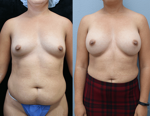 Breast Augmentation with Asymmetry Before & After Photos
