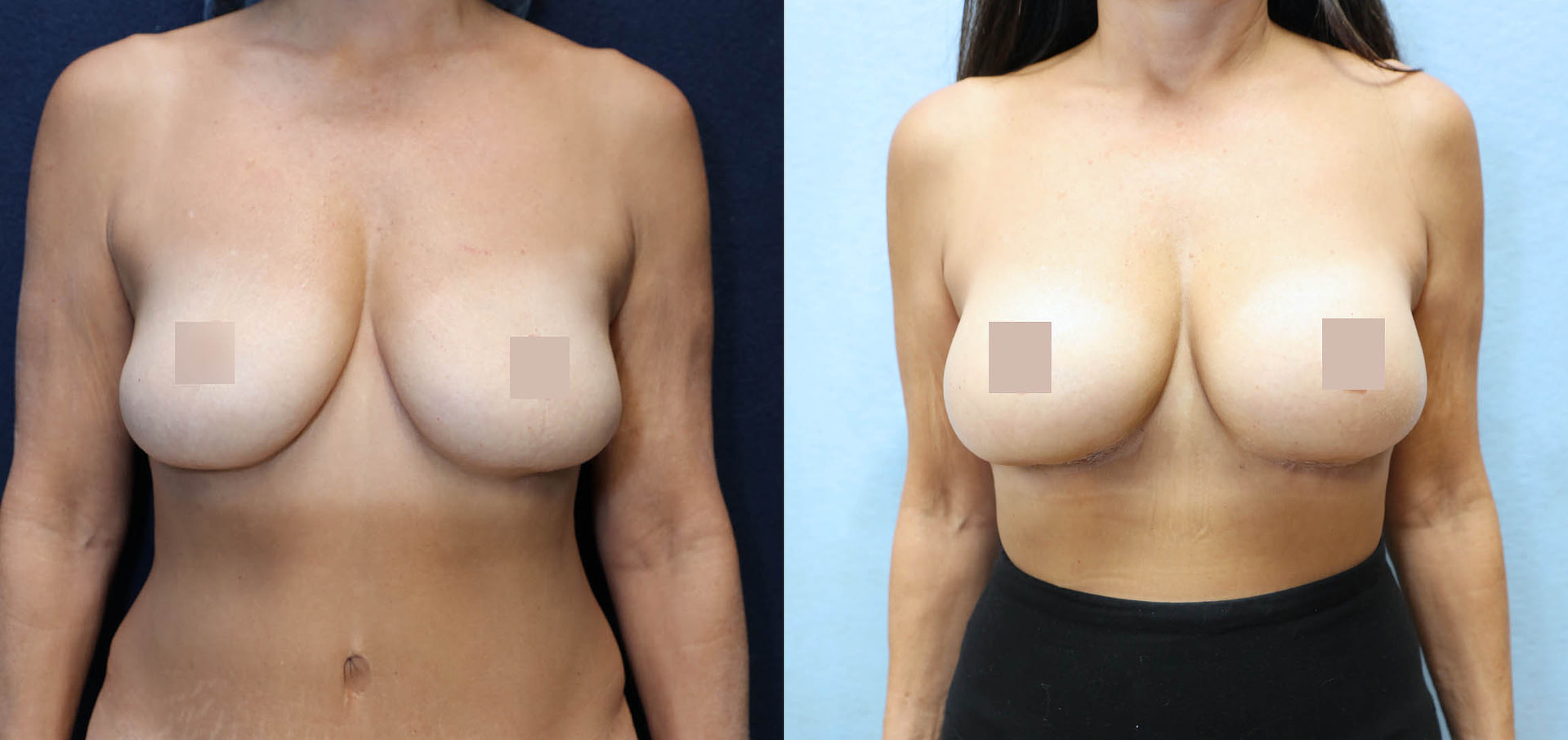 Breast Augmentation Asymmetry Before & After Photos