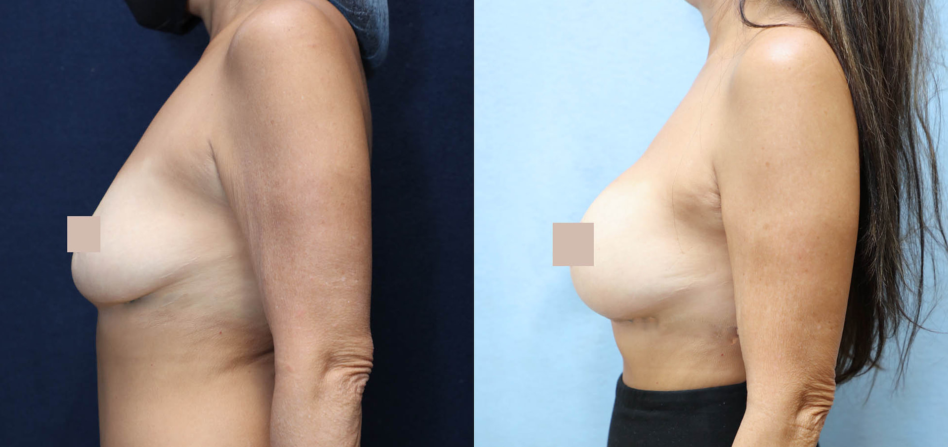 Breast Augmentation Asymmetry Before & After Photos