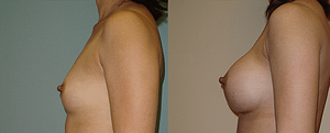 Breast Augmentation Before & After Photos Left