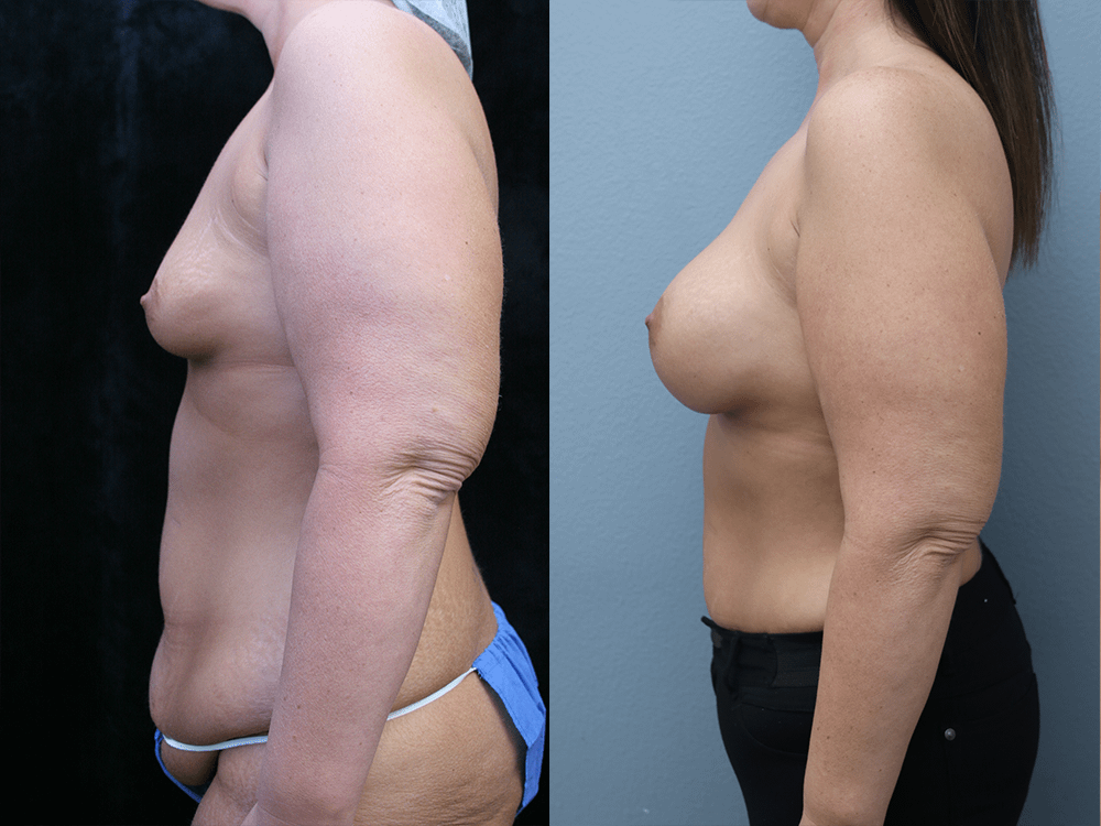 Breast Augmentation with Asymmetry Before & After Photos Left Side
