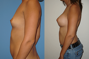 Breast Augmentation Before & After Photos Left
