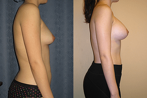 Breast Augmentation Before & After Photos