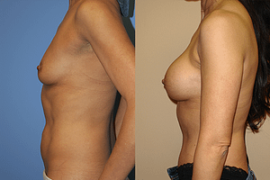 Breast Augmentation Before & After Photos Left