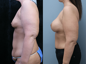 Breast Augmentation Before & After Photos Right