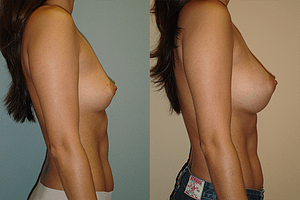 Breast Augmentation Before & After Photos Right