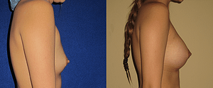 Breast Augmentation Before & After Photos Right