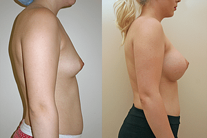 Breast Augmentation Before & After Photos Right