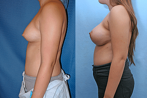 Breast Augmentation Before & After Photos