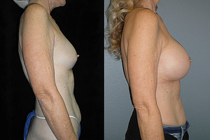 Breast Augmentation Before & After Photos