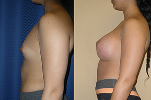 Breast Augmentation Before & After Photos