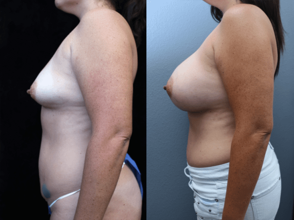 Breast Augmentation with Asymmetry Before & After Photos Left Side
