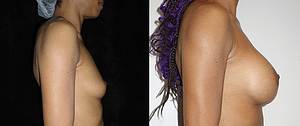 Breast Augmentation Before & After Photos Right