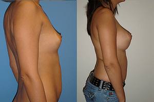 Breast Augmentation Before & After Photos Right