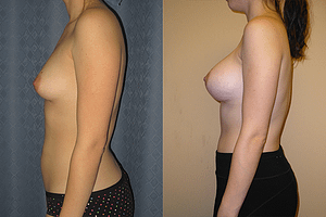 Breast Augmentation Before & After Photos Left