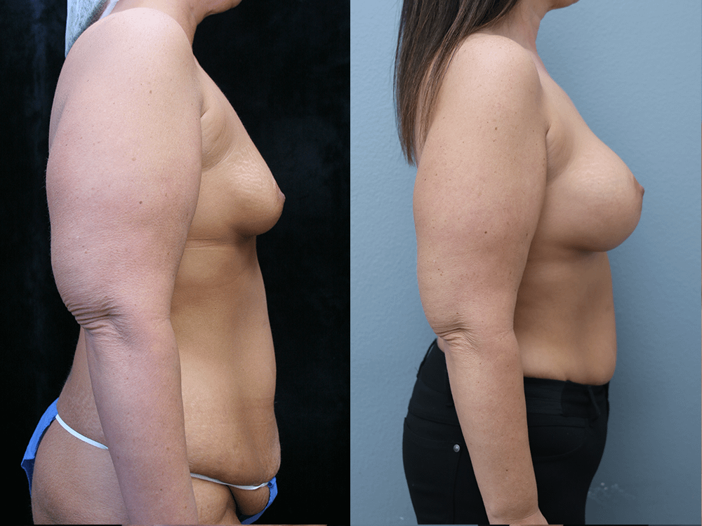 Breast Augmentation with Asymmetry Before & After Photos Right Side