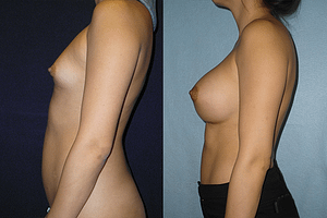 Breast Augmentation Before & After Photos Left