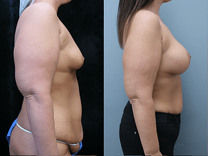 Breast Augmentation Before & After Photos