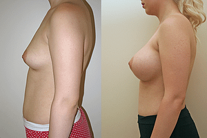 Breast Augmentation Before & After Photos Left