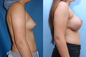 Breast Augmentation Before & After Photos