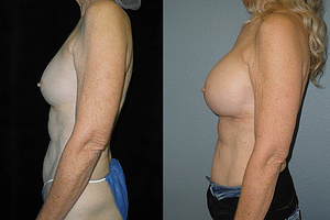 Breast Augmentation Before & After Photos