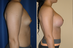 Breast Augmentation Before & After Photos