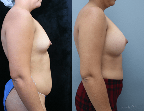 Breast Augmentation with Asymmetry Before & After Photos Right Side