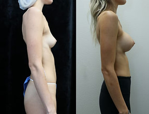 breast augmentation asymmetry before and after