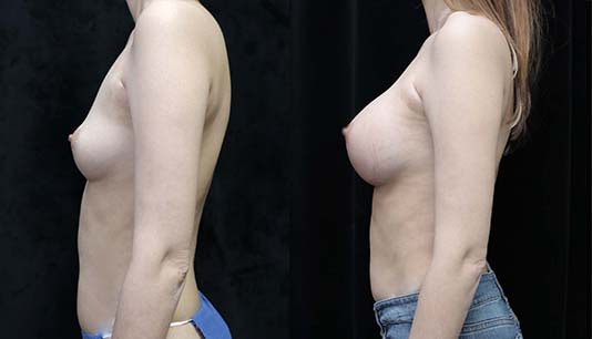 breast augmentation before and after