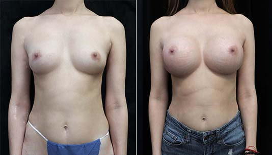 breast augmentation before and after