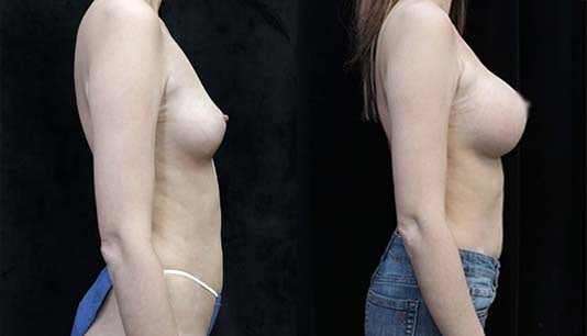 breast augmentation before and after right