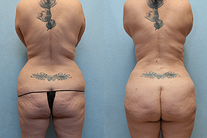 Brazilian Butt Lift