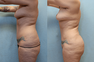 Brazilian Butt Lift