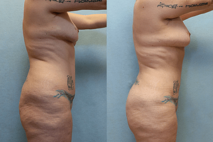 Brazilian Butt Lift