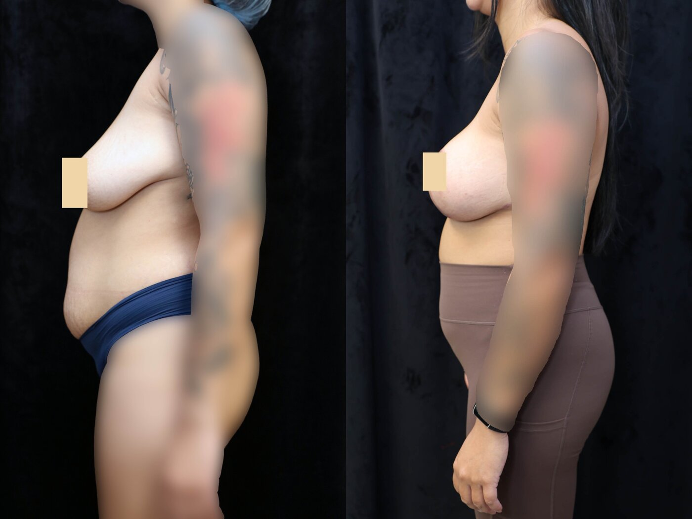 Breast Augmentation Before & After Photos