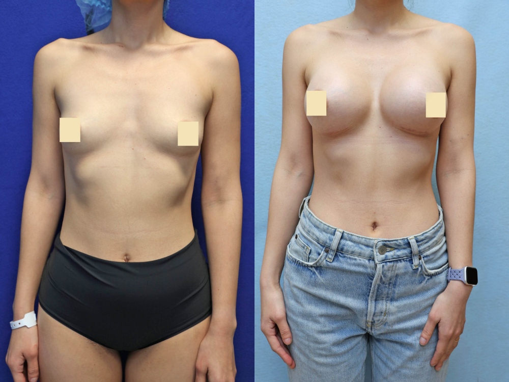 Breast Augmentation Before & After Photos