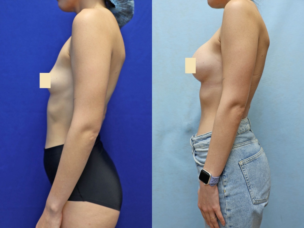 Breast Augmentation Before & After Photos