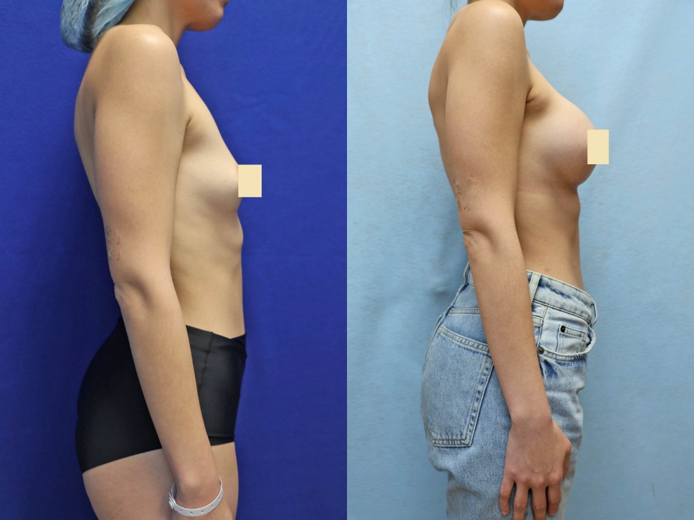 Breast Augmentation Before & After Photos