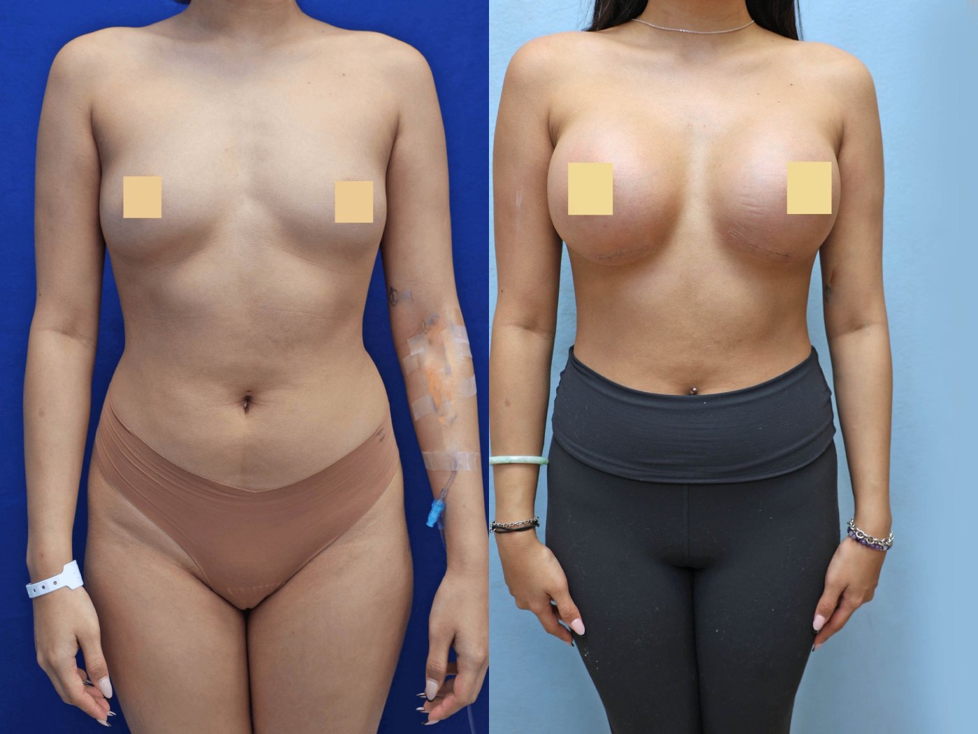 Breast Augmentation Before & After Photos