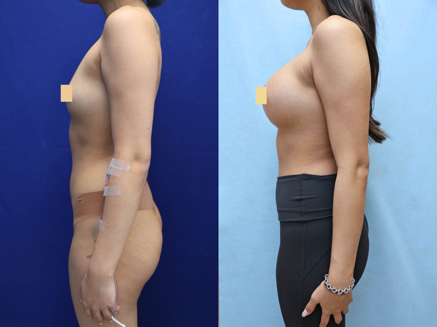 Breast Augmentation Before & After Photos